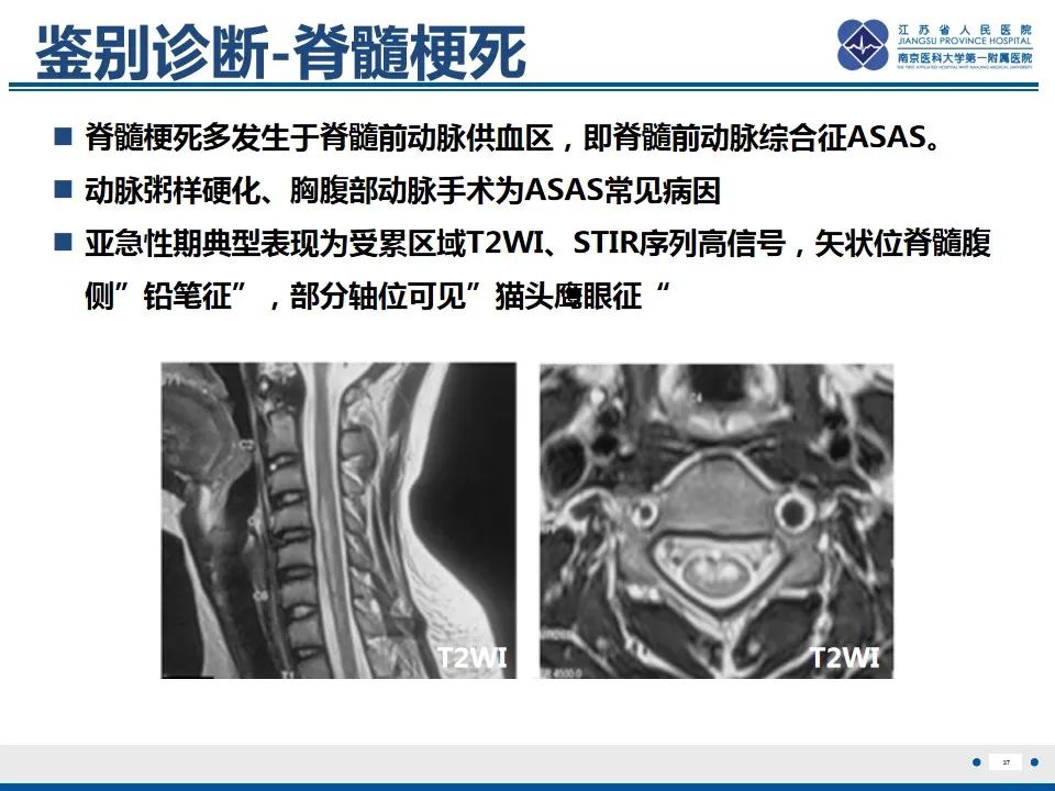 影像PPT - 【PPT】脊髓内脓肿-38