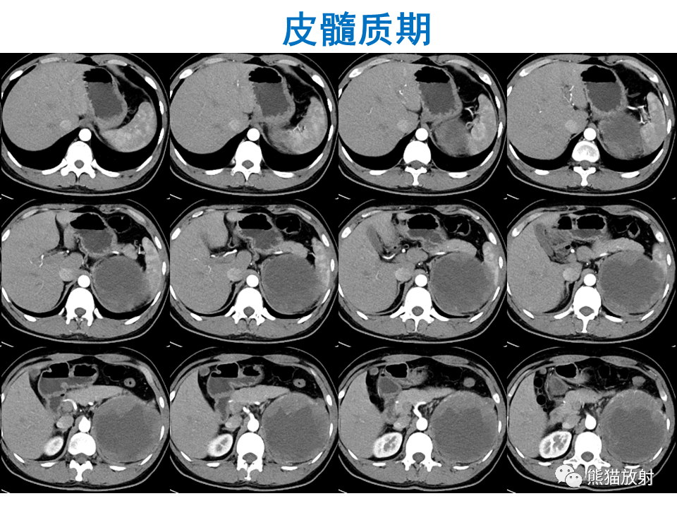影像PPT - 【PPT】肾脏神经内分泌肿瘤 VS 肾透明细胞癌-5