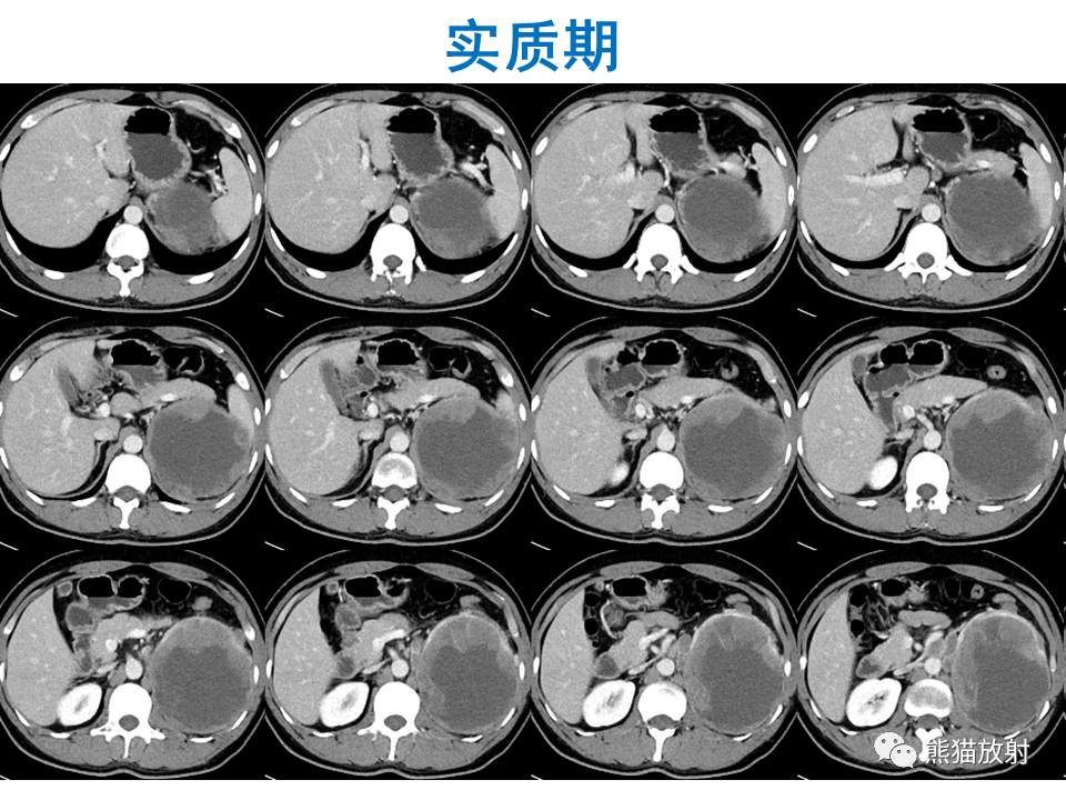 影像PPT - 【PPT】肾脏神经内分泌肿瘤 VS 肾透明细胞癌-7