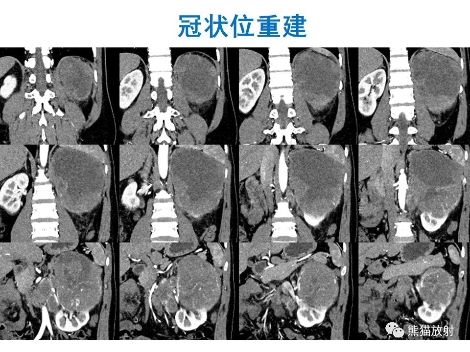影像PPT - 【PPT】肾脏神经内分泌肿瘤 VS 肾透明细胞癌-11