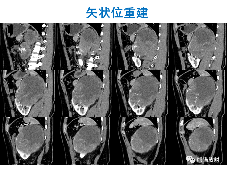 影像PPT - 【PPT】肾脏神经内分泌肿瘤 VS 肾透明细胞癌-12
