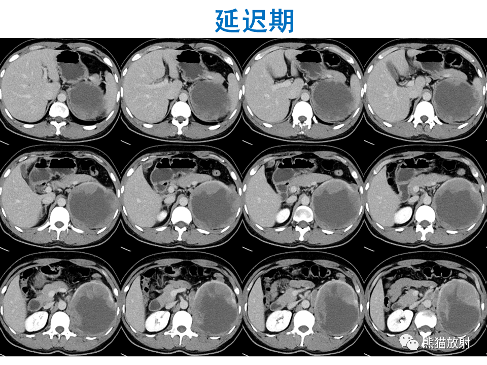 影像PPT - 【PPT】肾脏神经内分泌肿瘤 VS 肾透明细胞癌-9