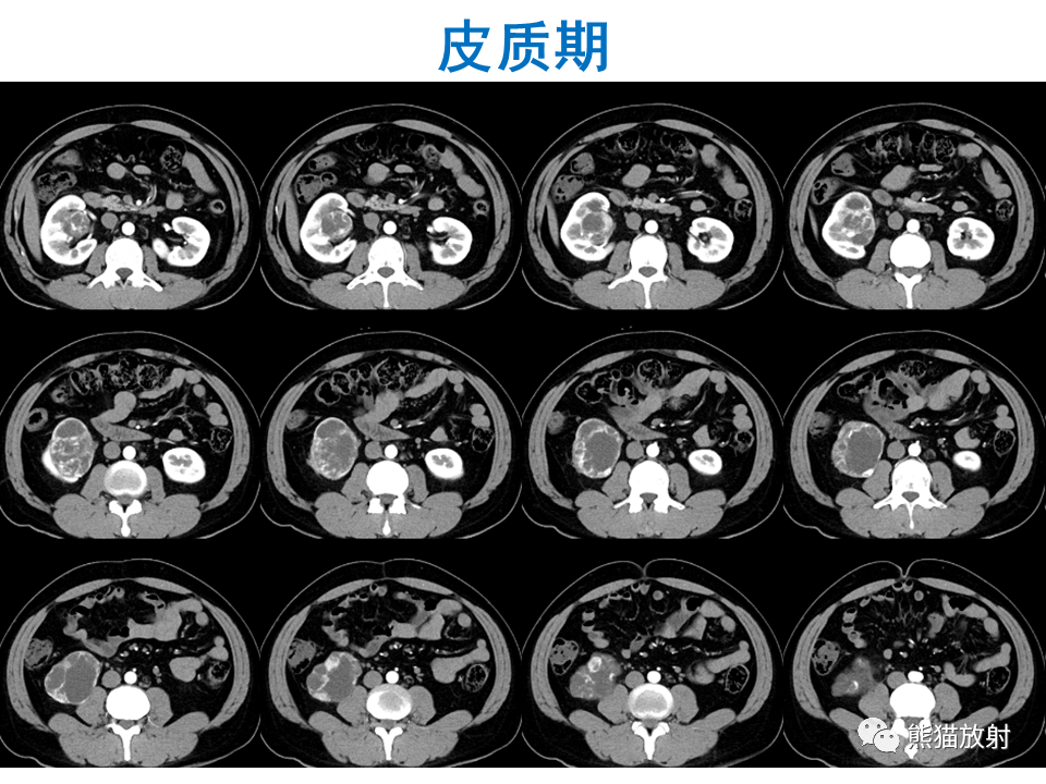 影像PPT - 【PPT】肾脏神经内分泌肿瘤 VS 肾透明细胞癌-17