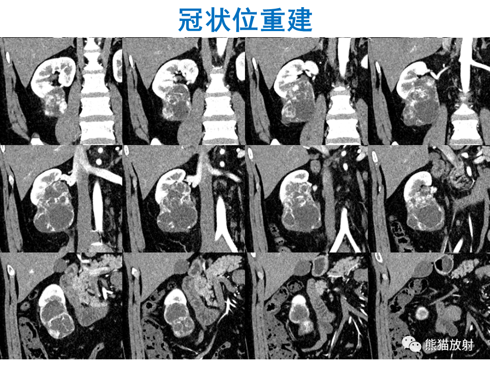 影像PPT - 【PPT】肾脏神经内分泌肿瘤 VS 肾透明细胞癌-20