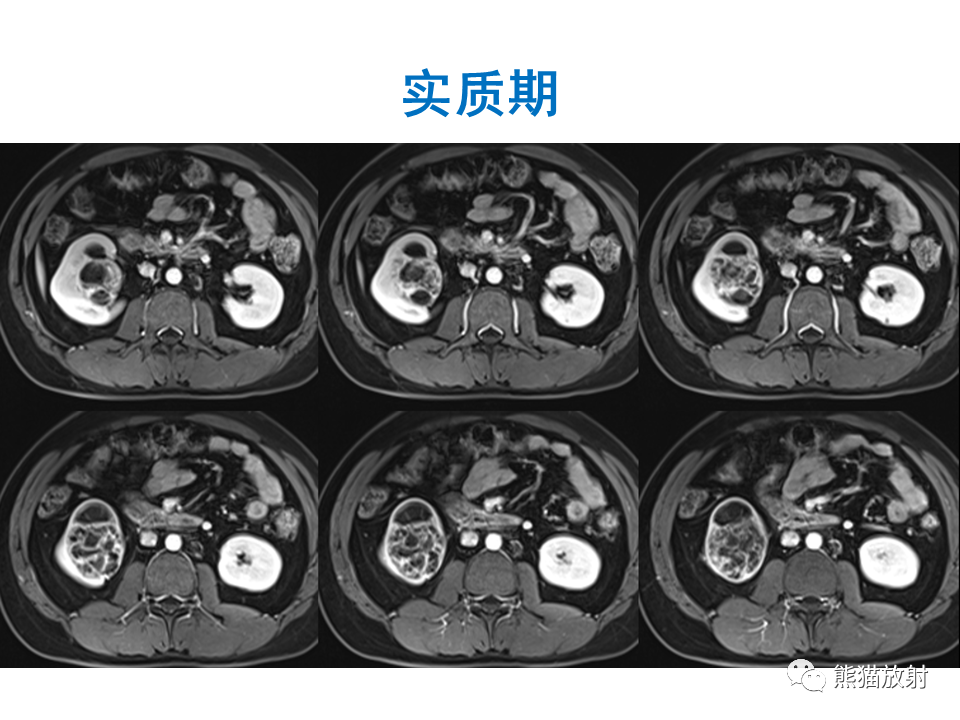 影像PPT - 【PPT】肾脏神经内分泌肿瘤 VS 肾透明细胞癌-30