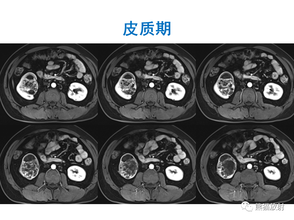 影像PPT - 【PPT】肾脏神经内分泌肿瘤 VS 肾透明细胞癌-29