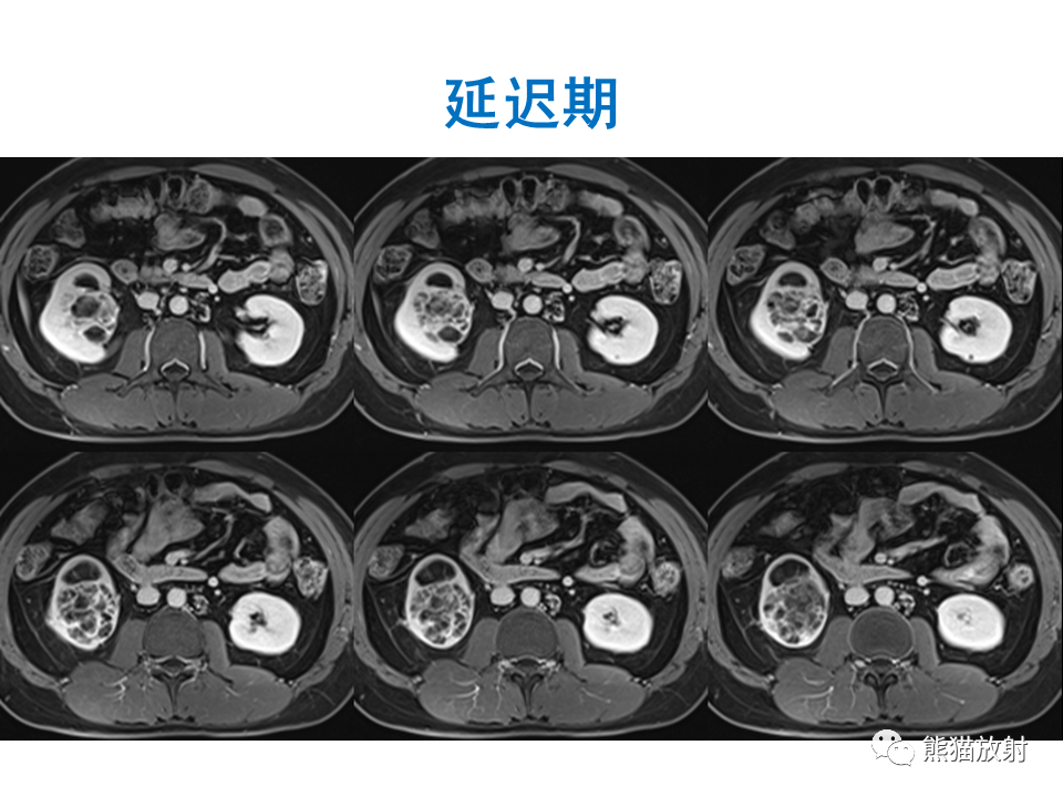 影像PPT - 【PPT】肾脏神经内分泌肿瘤 VS 肾透明细胞癌-31
