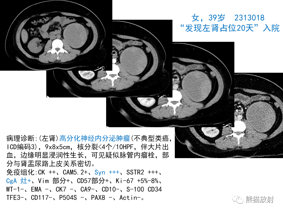 影像PPT - 【PPT】肾脏神经内分泌肿瘤 VS 肾透明细胞癌-43