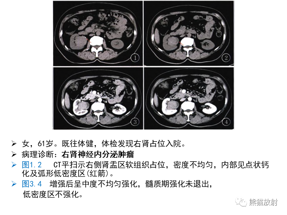 影像PPT - 【PPT】肾脏神经内分泌肿瘤 VS 肾透明细胞癌-45