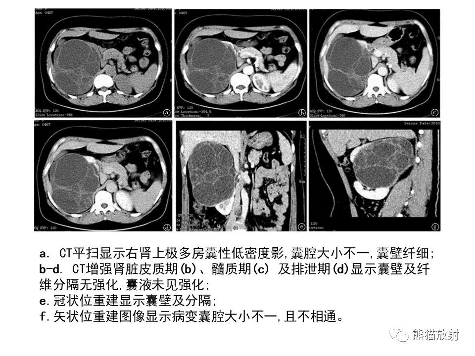 影像PPT - 【PPT】肾脏神经内分泌肿瘤 VS 肾透明细胞癌-50