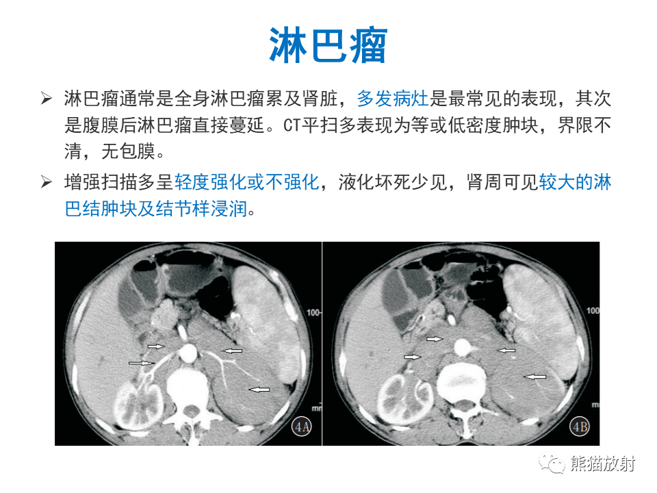 影像PPT - 【PPT】肾脏神经内分泌肿瘤 VS 肾透明细胞癌-54