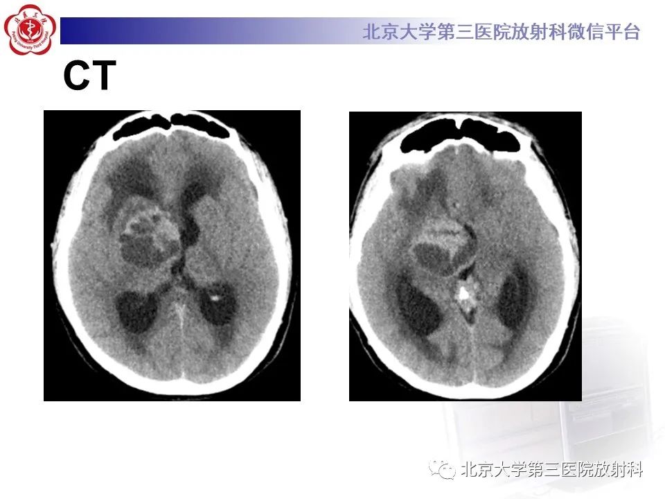 影像PPT - 【PPT】颅内生殖细胞瘤-3