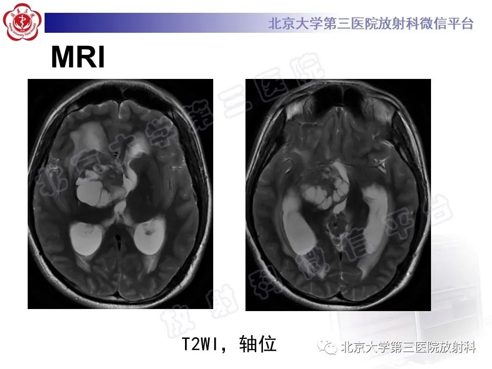 影像PPT - 【PPT】颅内生殖细胞瘤-5