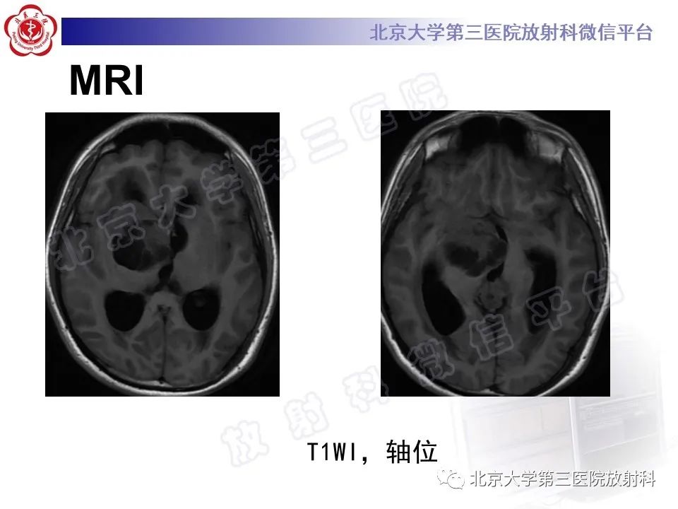 影像PPT - 【PPT】颅内生殖细胞瘤-4