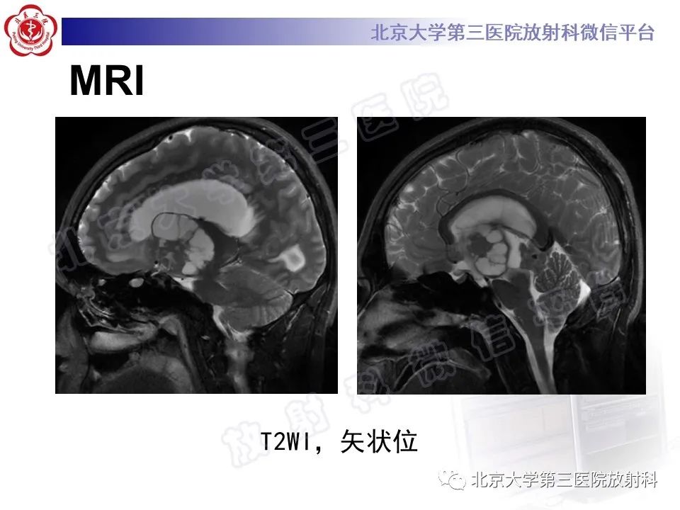 影像PPT - 【PPT】颅内生殖细胞瘤-6