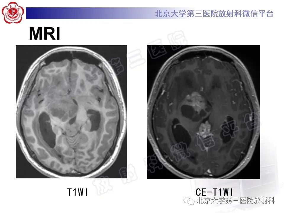 影像PPT - 【PPT】颅内生殖细胞瘤-8