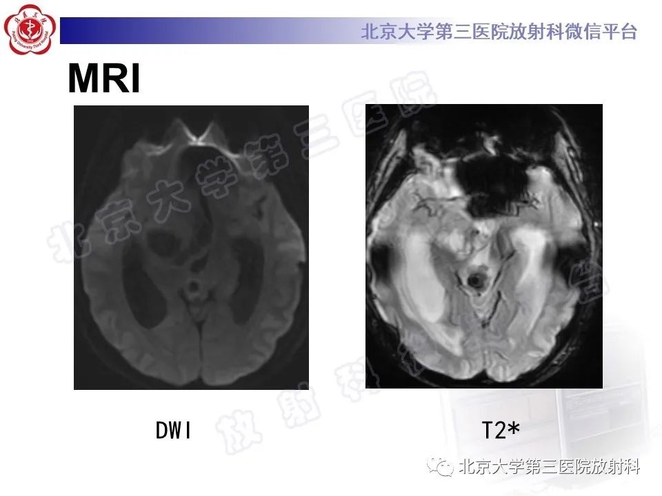 影像PPT - 【PPT】颅内生殖细胞瘤-7