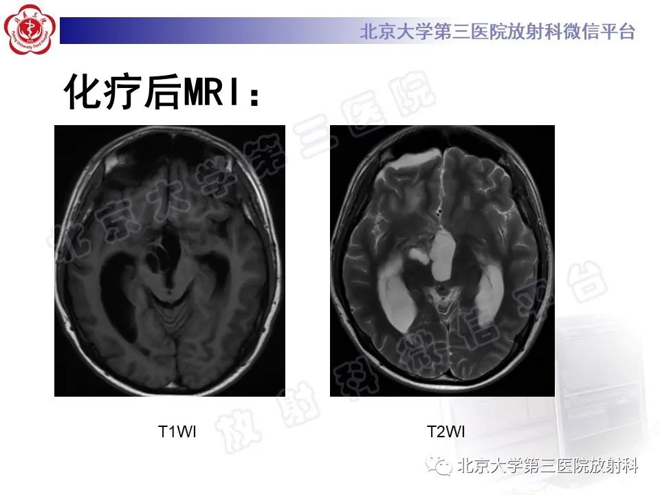 影像PPT - 【PPT】颅内生殖细胞瘤-12
