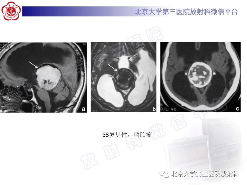 影像PPT - 【PPT】颅内生殖细胞瘤-23