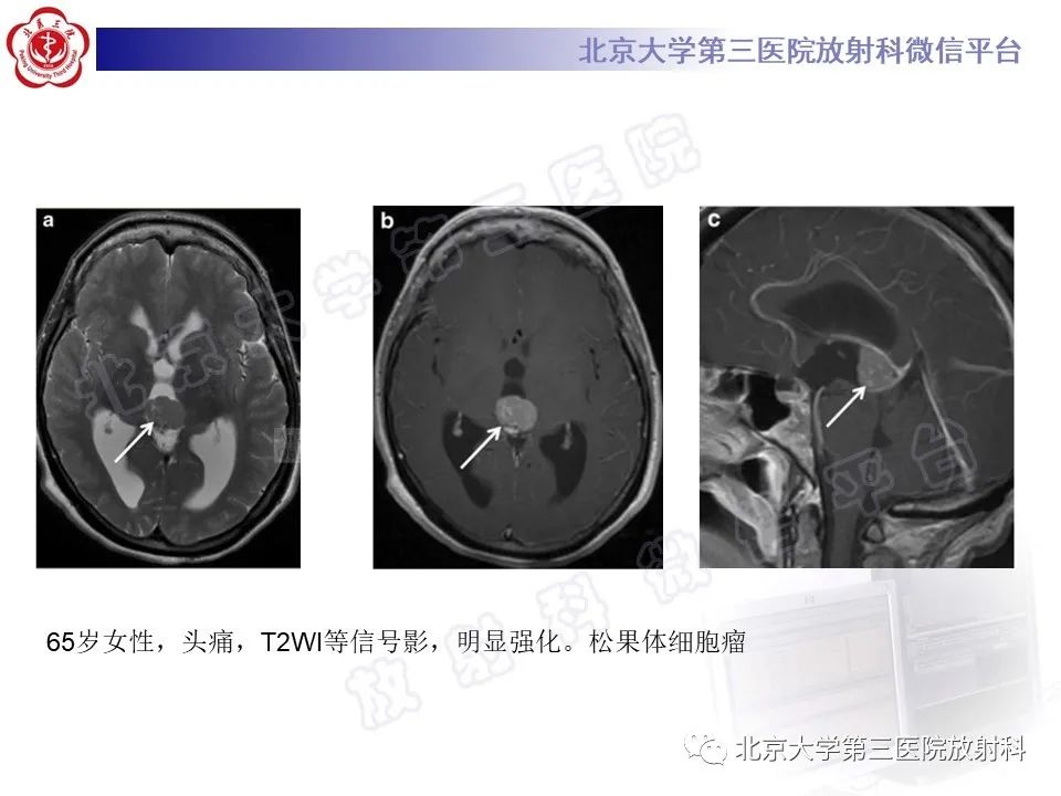 影像PPT - 【PPT】颅内生殖细胞瘤-26