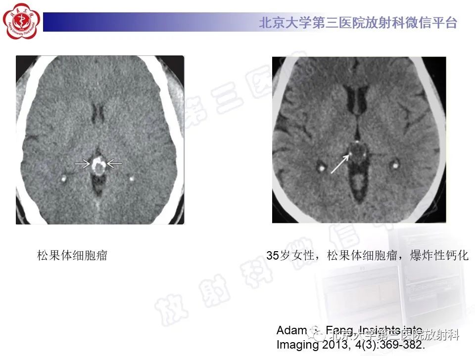 影像PPT - 【PPT】颅内生殖细胞瘤-25