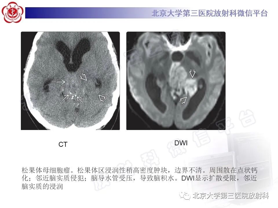 影像PPT - 【PPT】颅内生殖细胞瘤-28