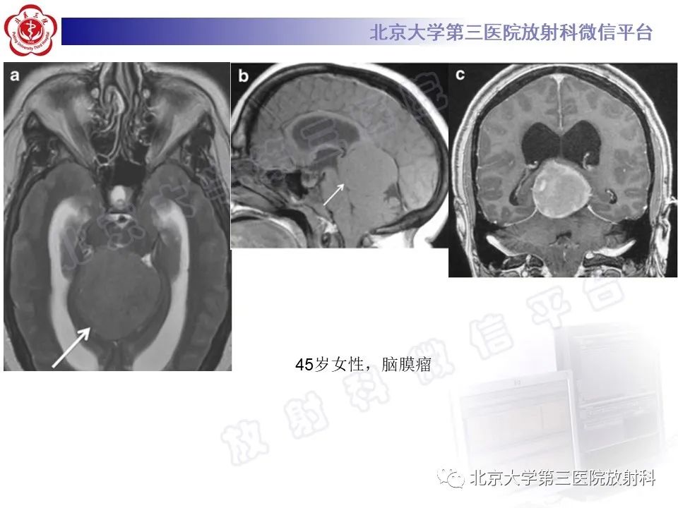 影像PPT - 【PPT】颅内生殖细胞瘤-30