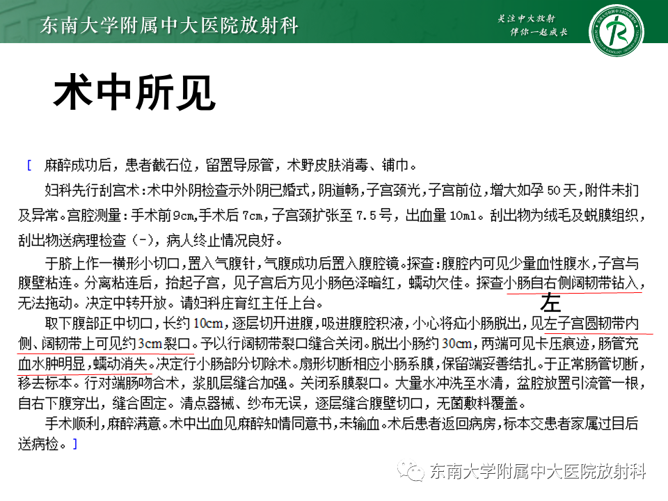 影像PPT - 【PPT】阔韧带疝-4