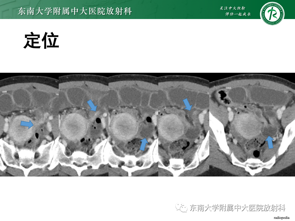 影像PPT - 【PPT】阔韧带疝-11