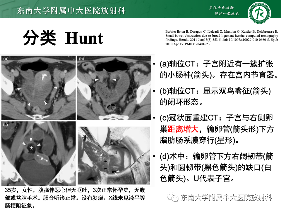 影像PPT - 【PPT】阔韧带疝-15