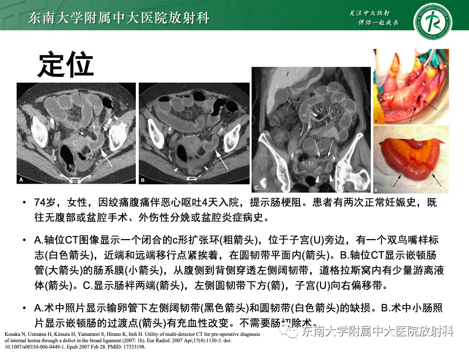 影像PPT - 【PPT】阔韧带疝-13
