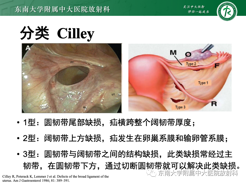 影像PPT - 【PPT】阔韧带疝-16