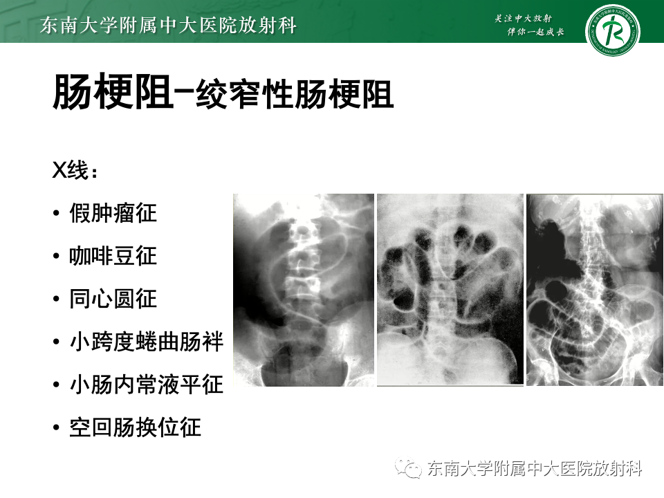 影像PPT - 【PPT】阔韧带疝-19
