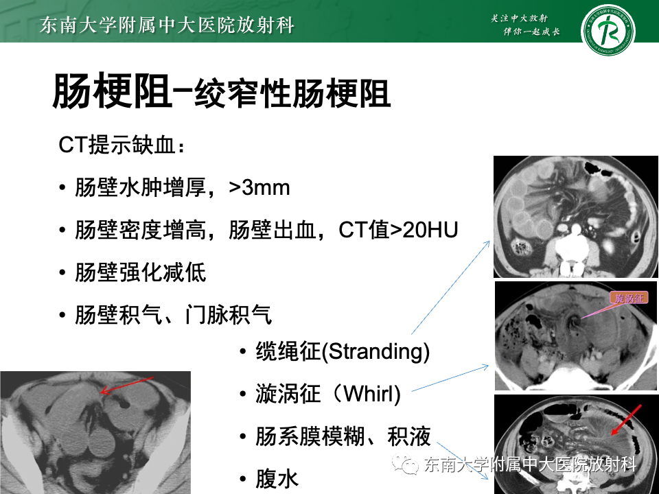 影像PPT - 【PPT】阔韧带疝-20