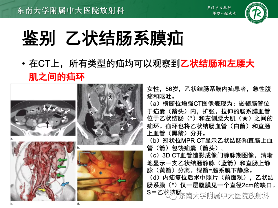影像PPT - 【PPT】阔韧带疝-23