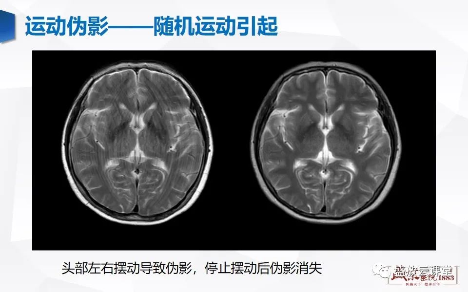 影像PPT - 【PPT】头部MR检查中常见的伪影-7