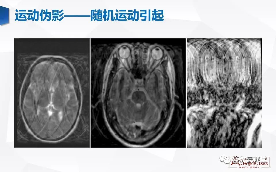 影像PPT - 【PPT】头部MR检查中常见的伪影-8