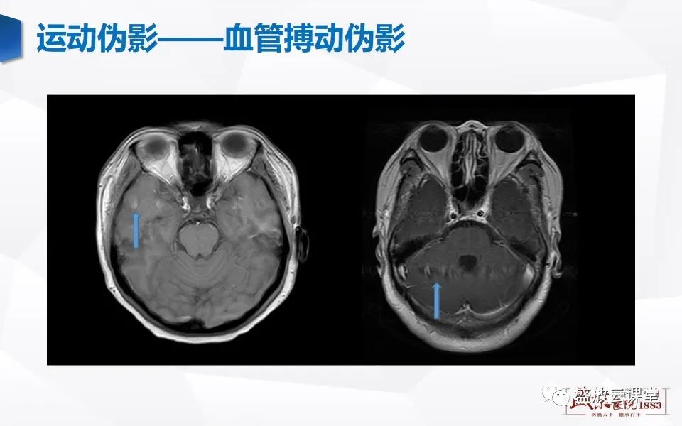 影像PPT - 【PPT】头部MR检查中常见的伪影-10