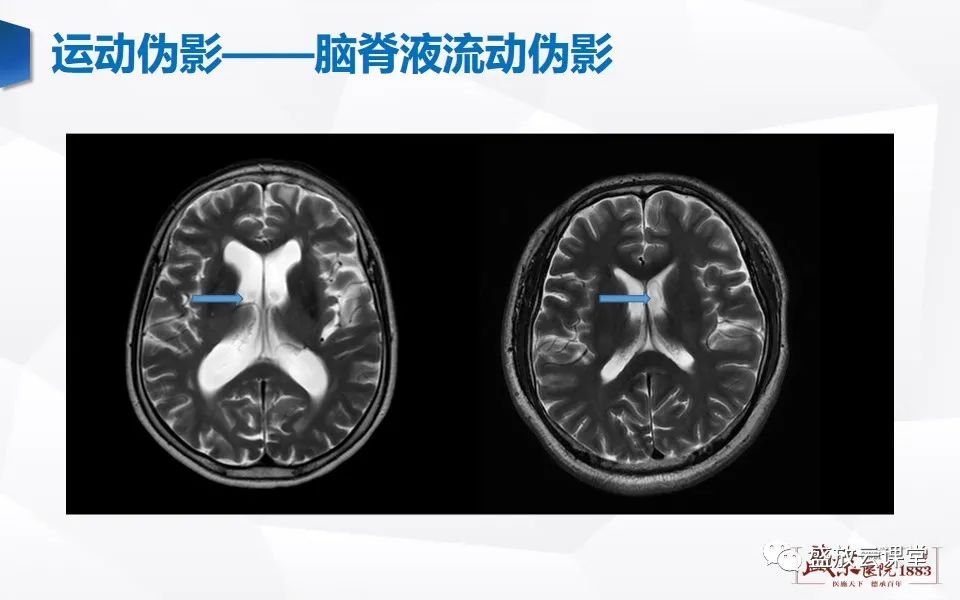 影像PPT - 【PPT】头部MR检查中常见的伪影-9