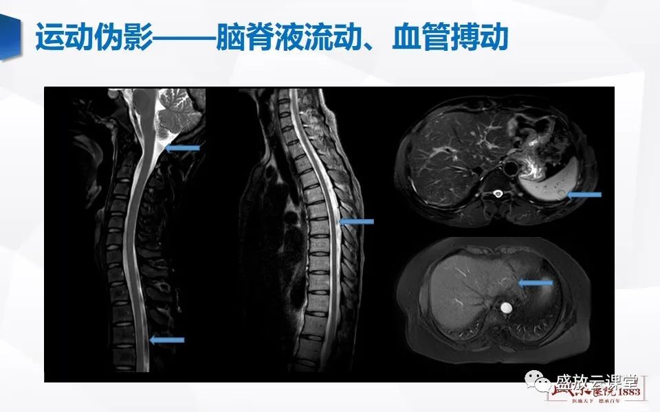 影像PPT - 【PPT】头部MR检查中常见的伪影-11