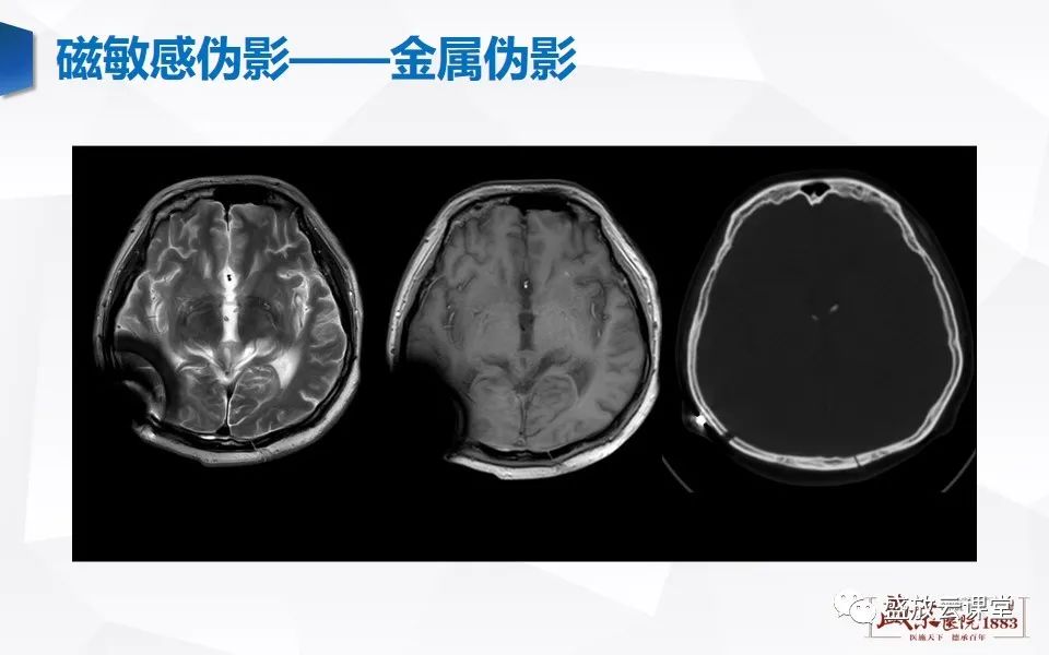 影像PPT - 【PPT】头部MR检查中常见的伪影-14