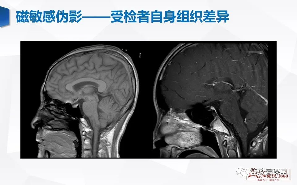 影像PPT - 【PPT】头部MR检查中常见的伪影-17