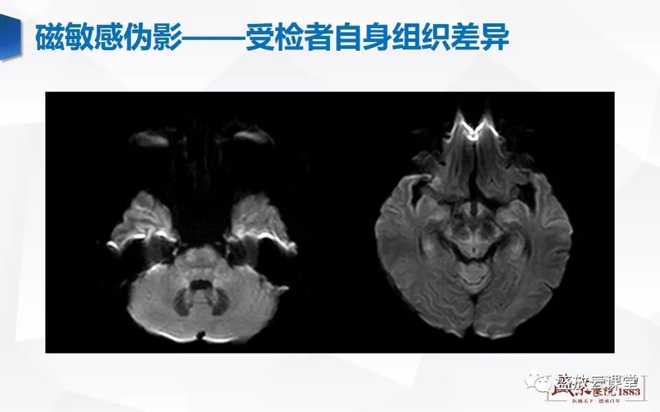 影像PPT - 【PPT】头部MR检查中常见的伪影-16
