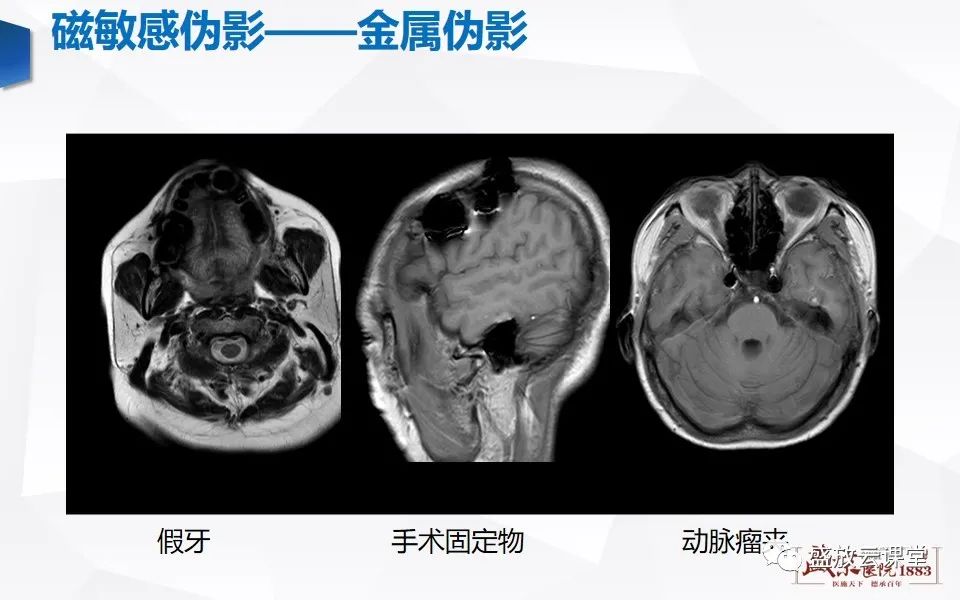 影像PPT - 【PPT】头部MR检查中常见的伪影-15