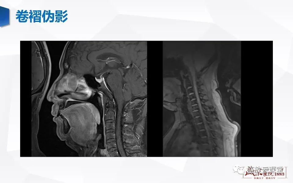 影像PPT - 【PPT】头部MR检查中常见的伪影-20