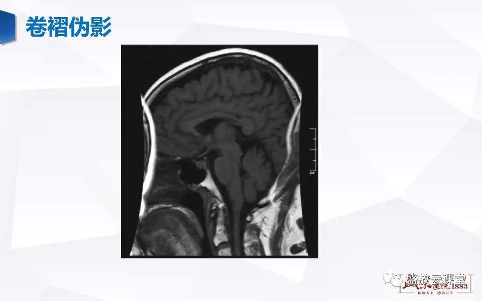 影像PPT - 【PPT】头部MR检查中常见的伪影-21