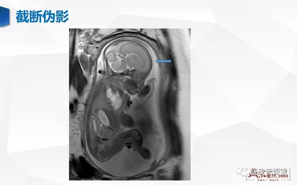 影像PPT - 【PPT】头部MR检查中常见的伪影-26