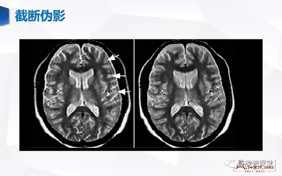 影像PPT - 【PPT】头部MR检查中常见的伪影-25