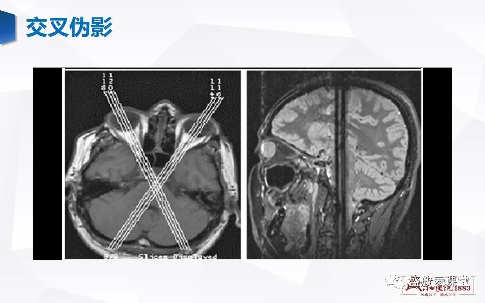 影像PPT - 【PPT】头部MR检查中常见的伪影-29