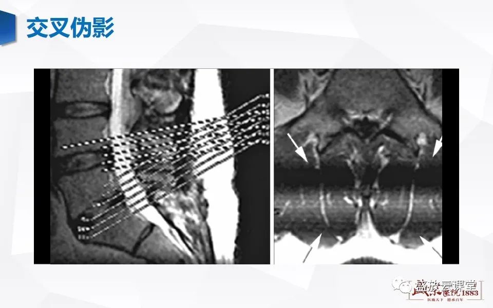 影像PPT - 【PPT】头部MR检查中常见的伪影-30